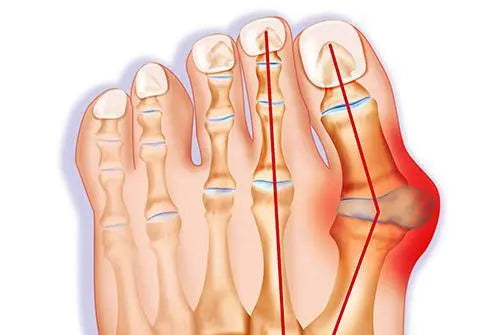 Sandales pour oignons : soulager la douleur des oignons sans chirurgie